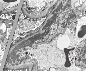 M,19y. | membranous glomerulopathy - lupus erythematodes st. IV